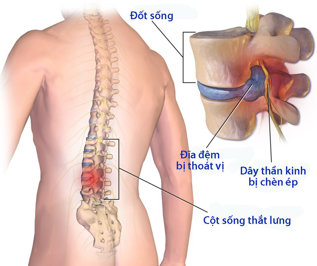 Degenerative Disc Disease - Hình ảnh minh họa